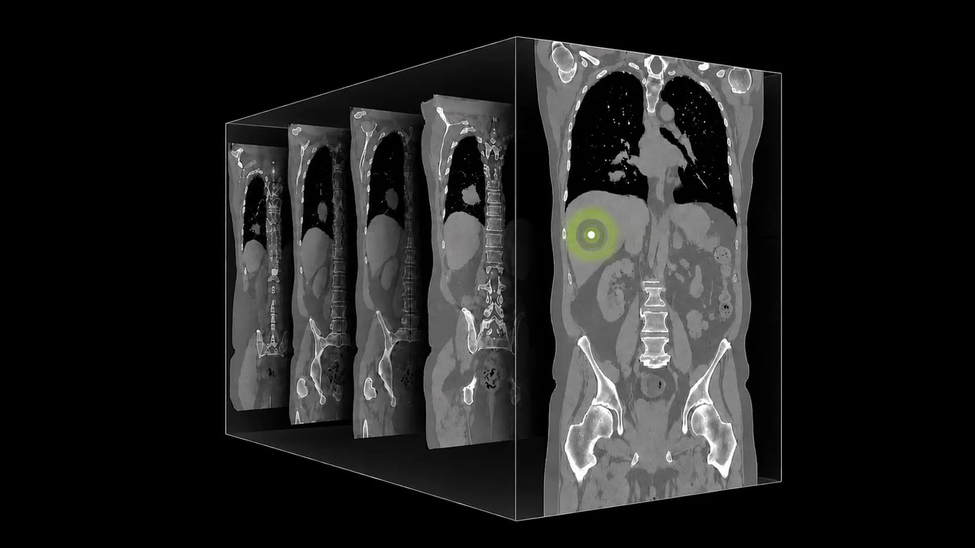 NVIDIA 推出首款開源 3D CT 醫療視覺語言模型 NV-Reason-CT，導入放射科醫師思考鏈推論